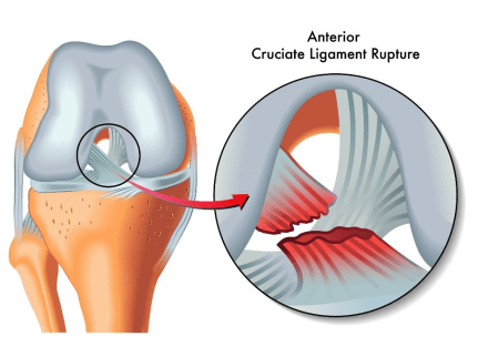 acl tear sports injury