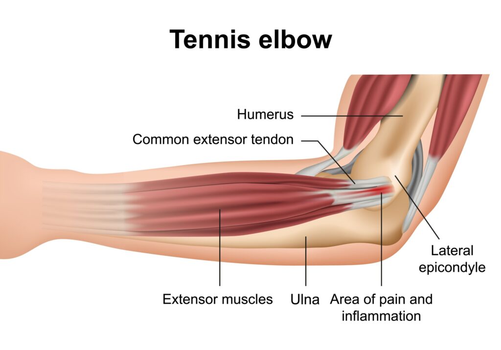 tennis elbow sports injury